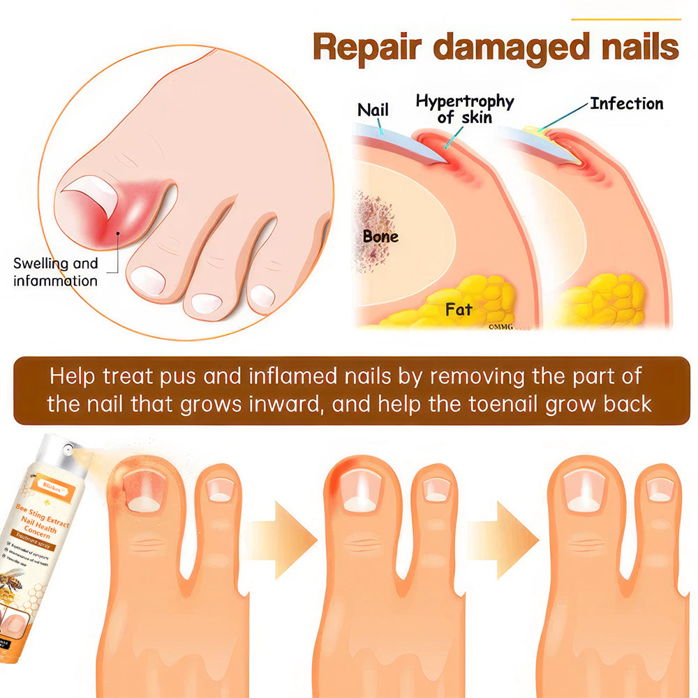 💥 70% OFF ️⏳ Bee Sting Extract Nail Health Concern Spray 💥 Fix All Nail Problems within 2 Weeks