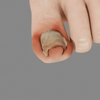 💥  70% OFF ️⏳  Bee Sting Extract Nail Health Concern Spray 💥 Fix All Nail Problems within 2 Weeks