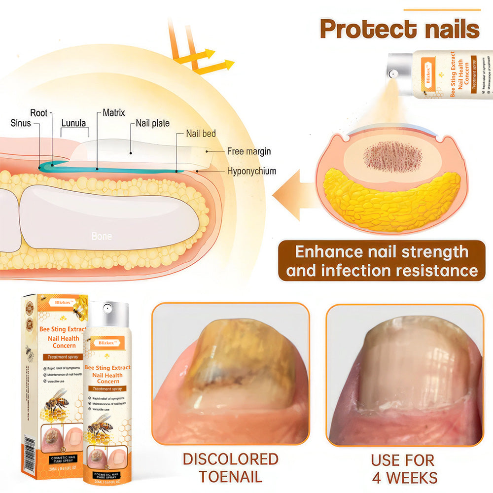 💥  70% OFF ️⏳  Bee Sting Extract Nail Health Concern Spray 💥 Fix All Nail Problems within 2 Weeks